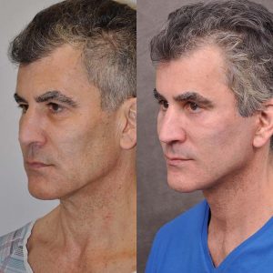AuraLyft for Men with rejunenation around the eyes - Left Side