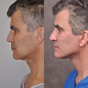 AuraLyft for Men with rejunenation around the eyes - Left Side
