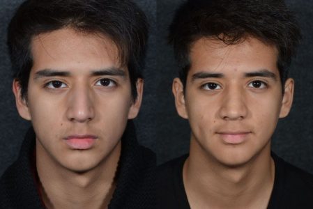 Minimally Invasive (Closed) Rhinoplasty - Front