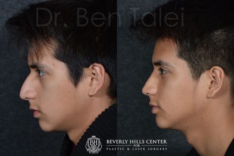 Minimally Invasive (Closed) Rhinoplasty - Front