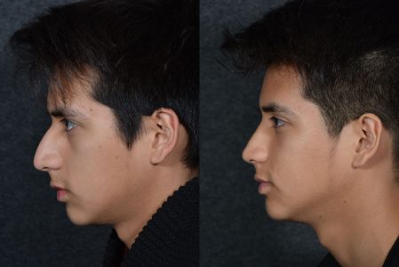 Minimally Invasive (Closed) Rhinoplasty - Left Side