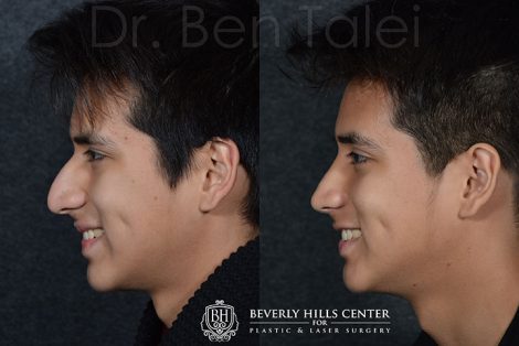 Minimally Invasive (Closed) Rhinoplasty - Left Side