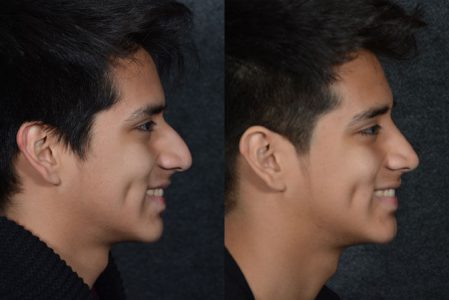 Minimally Invasive (Closed) Rhinoplasty - Right Side