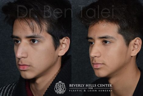 Minimally Invasive (Closed) Rhinoplasty - Right Side