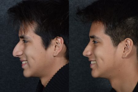 Minimally Invasive (Closed) Rhinoplasty - Left Side