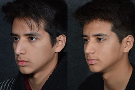 Minimally Invasive (Closed) Rhinoplasty - Left Side