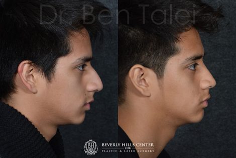 Minimally Invasive (Closed) Rhinoplasty - Left Side