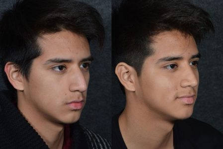 Minimally Invasive (Closed) Rhinoplasty - Right Side