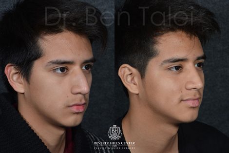 Minimally Invasive (Closed) Rhinoplasty - Right Side