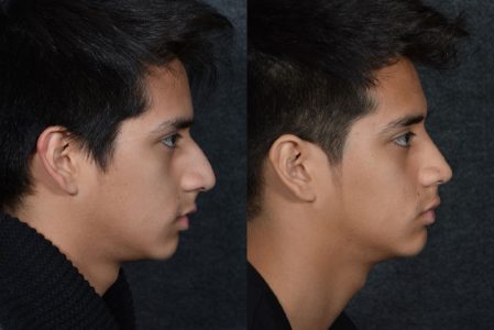 Minimally Invasive (Closed) Rhinoplasty - Right Side