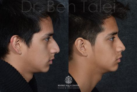 Minimally Invasive (Closed) Rhinoplasty - Right Side