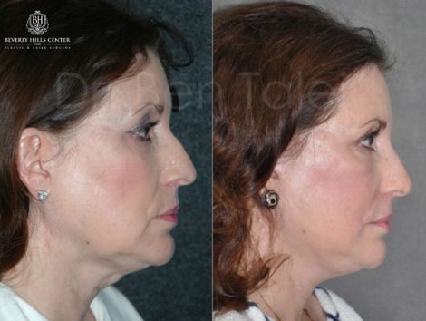 Beverly Hills Center Female Patient Before and After Non Surgical Liquid Rhinoplasty