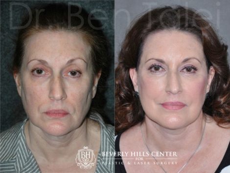 Beverly Hills Center Female Patient Before and After AuraLyft Procedure