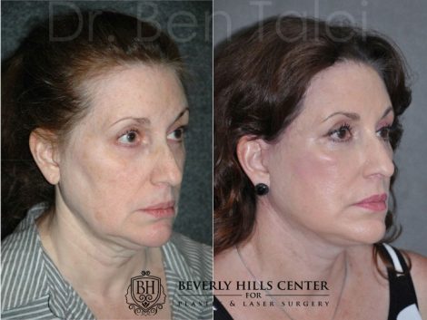 Beverly Hills Center Female Patient Before and After AuraLyft Procedure