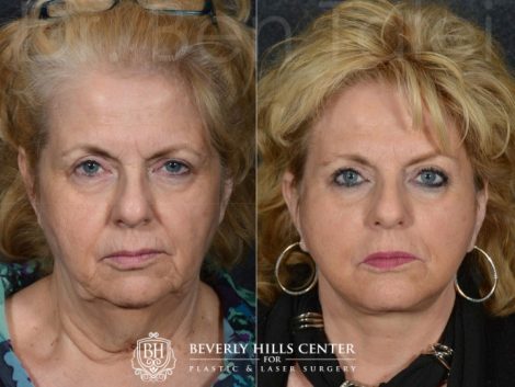 Face and Neck Lift - Front