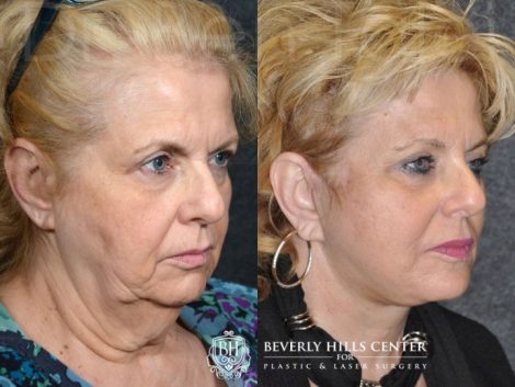 Face and Neck Lift - Right Side