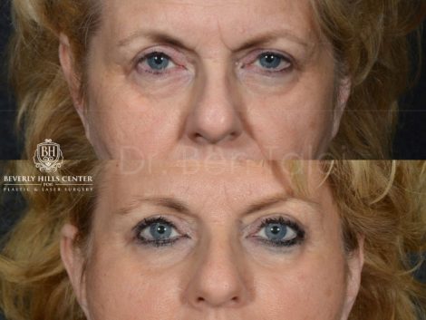 Beverly Hills Center Female Patient Before and After Endosopic Brow Lift Procedure