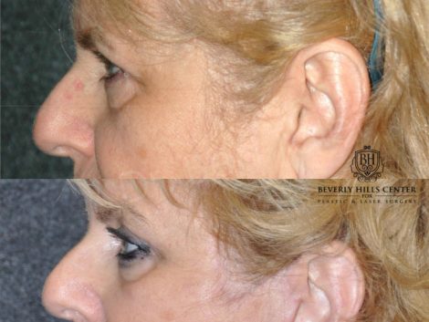 Beverly Hills Center Female Patient Before and After Endosopic Brow Lift Procedure