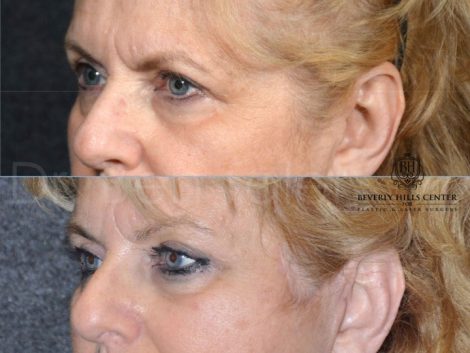 Beverly Hills Center Female Patient Before and After Endosopic Brow Lift Procedure