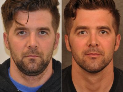 Microliposuction of Neck & Chin with under eye fillers and dysport - Front