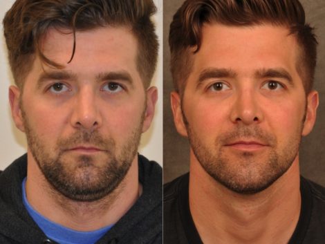 Microliposuction of Neck & Chin with under eye fillers and dysport - Front