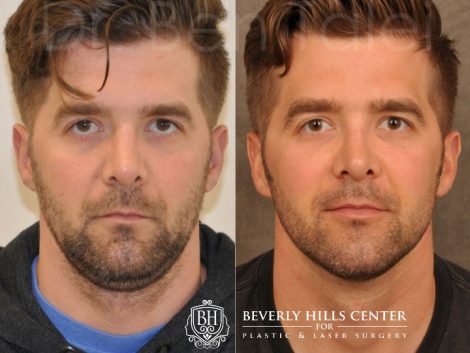 Microliposuction of Neck & Chin with under eye fillers and dysport - Front