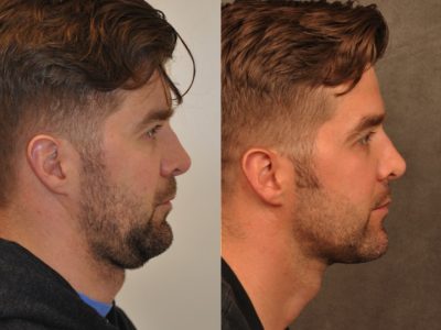 Microliposuction of Neck & Chin with under eye fillers and dysport - Right Side