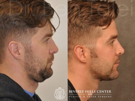 Microliposuction of Neck & Chin with under eye fillers and dysport - Right Side