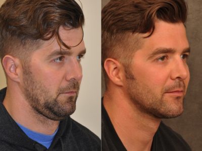Microliposuction of Neck & Chin with under eye fillers and dysport - Right Side