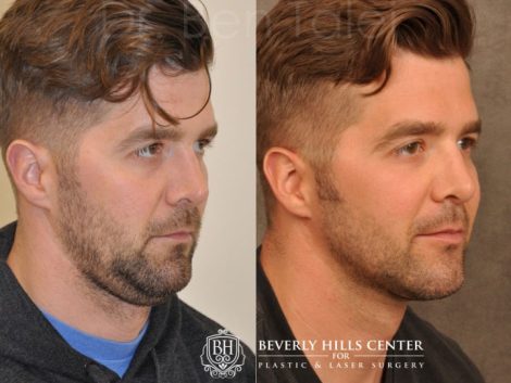 Microliposuction of Neck & Chin with under eye fillers and dysport - Right Side