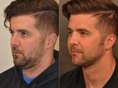 Microliposuction of Neck & Chin with under eye fillers and dysport - Left Side
