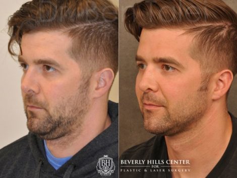 Microliposuction of Neck & Chin with under eye fillers and dysport - Left Side