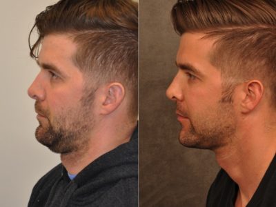 Microliposuction of Neck & Chin with under eye fillers and dysport - Left Side