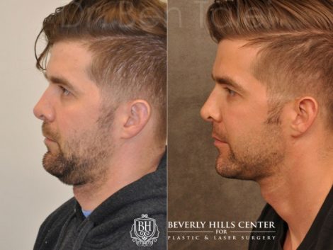 Microliposuction of Neck & Chin with under eye fillers and dysport - Left Side