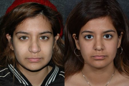 Minimally Invasive (Closed) Revision Rhinoplasty, Septoplasty and Nostril Lightening - Front