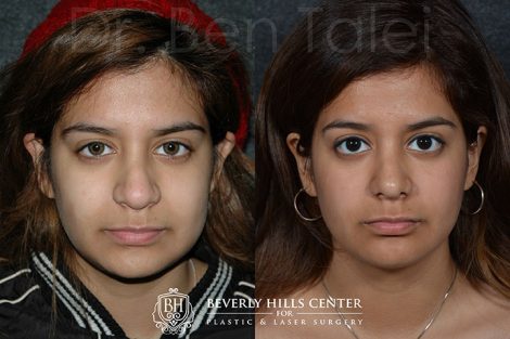 Minimally Invasive (Closed) Revision Rhinoplasty, Septoplasty and Nostril Lightening - Front