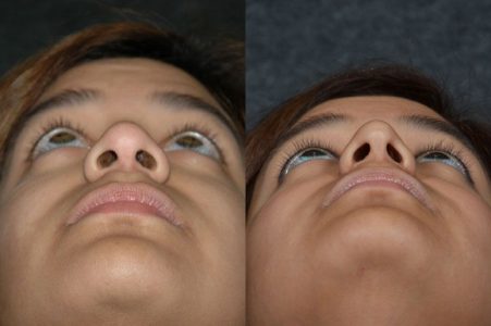 Minimally Invasive (Closed) Revision Rhinoplasty, Septoplasty and Nostril Lightening