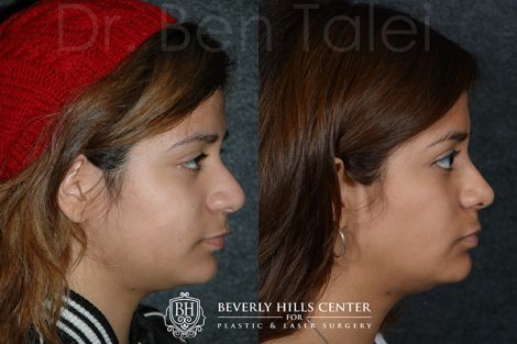 Minimally Invasive (Closed) Revision Rhinoplasty, Septoplasty and Nostril Lightening