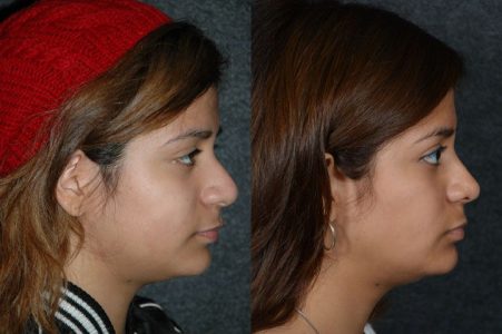 Minimally Invasive (Closed) Revision Rhinoplasty, Septoplasty and Nostril Lightening - Right Side