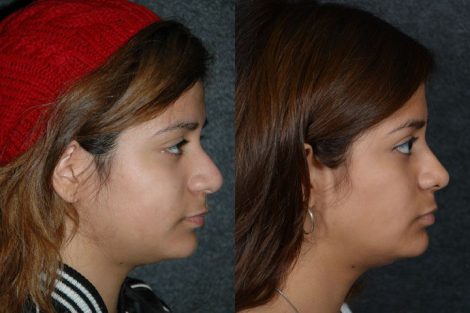 Minimally Invasive (Closed) Revision Rhinoplasty, Septoplasty and Nostril Lightening - Right Side