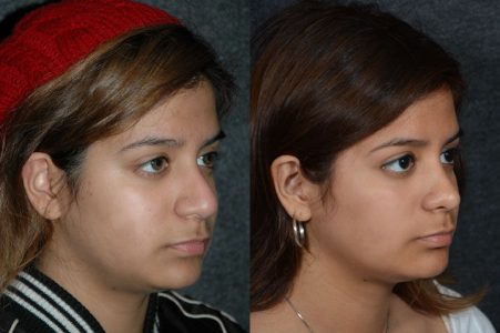 Minimally Invasive (Closed) Revision Rhinoplasty, Septoplasty and Nostril Lightening - Right Side
