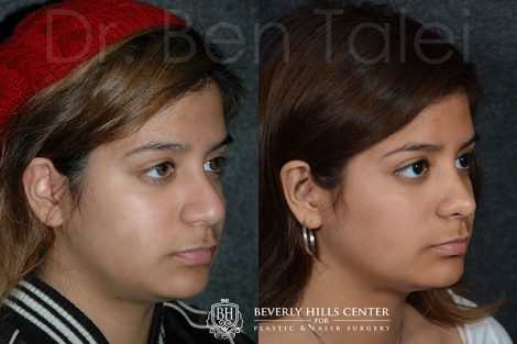 Minimally Invasive (Closed) Revision Rhinoplasty, Septoplasty and Nostril Lightening - Right Side