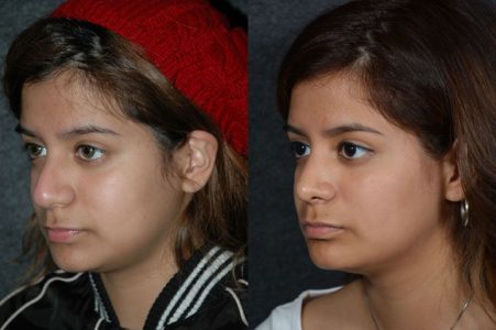 Minimally Invasive (Closed) Revision Rhinoplasty, Septoplasty and Nostril Lightening - Left Side