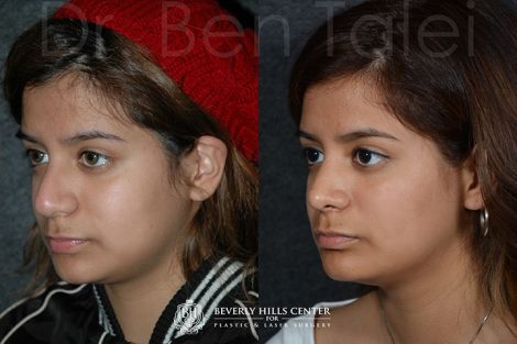Minimally Invasive (Closed) Revision Rhinoplasty, Septoplasty and Nostril Lightening - Left Side