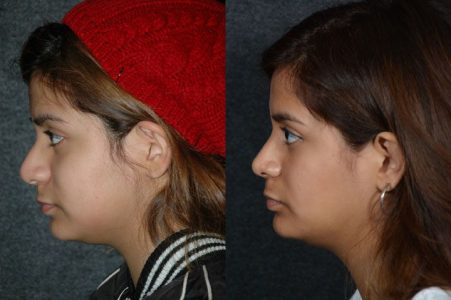 Minimally Invasive (Closed) Revision Rhinoplasty, Septoplasty and Nostril Lightening - Left Side