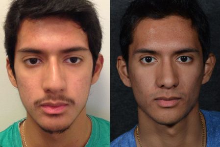 Minimally Invasive (Closed) Rhinoplasty, Septoplasty and Nostril Lightening - Front