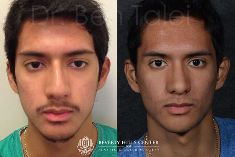 Minimally Invasive (Closed) Rhinoplasty, Septoplasty and Nostril Lightening - Front