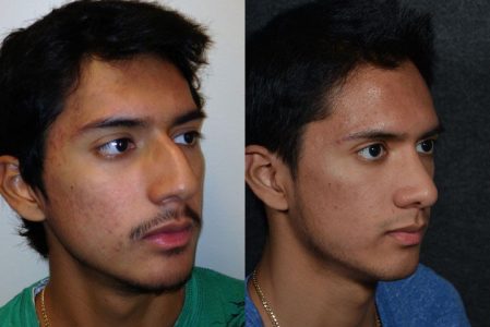 Minimally Invasive (Closed) Rhinoplasty, Septoplasty and Nostril Lightening - Right Side