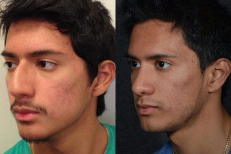 Minimally Invasive (Closed) Rhinoplasty, Septoplasty and Nostril Lightening - Left Side
