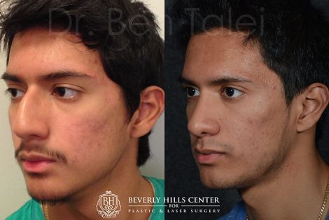 Minimally Invasive (Closed) Rhinoplasty, Septoplasty and Nostril Lightening - Left Side
